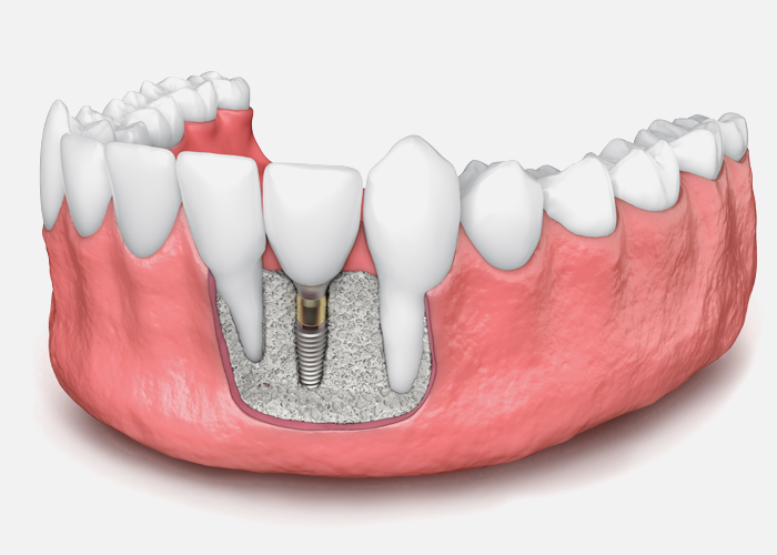 bone graft