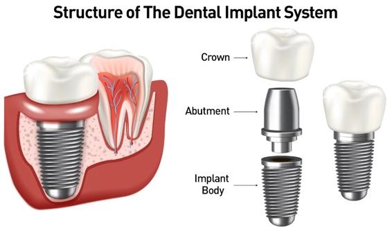 Dental implant system