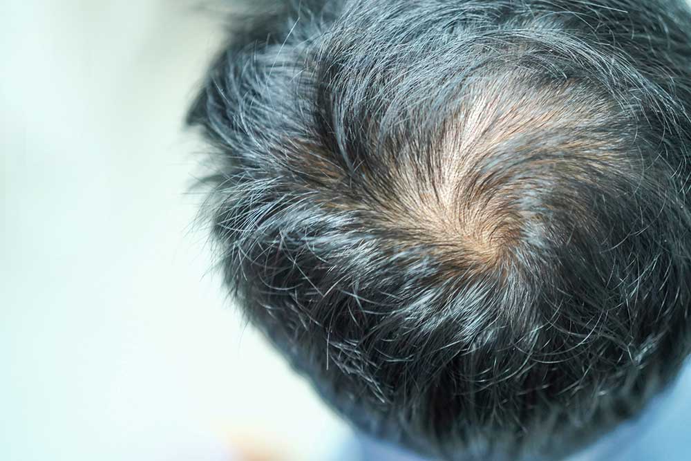 Hair Transplant