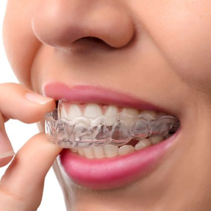 invisalign braces