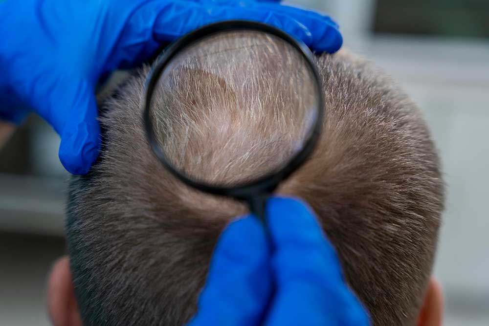 prepare for fue hair transplant operation