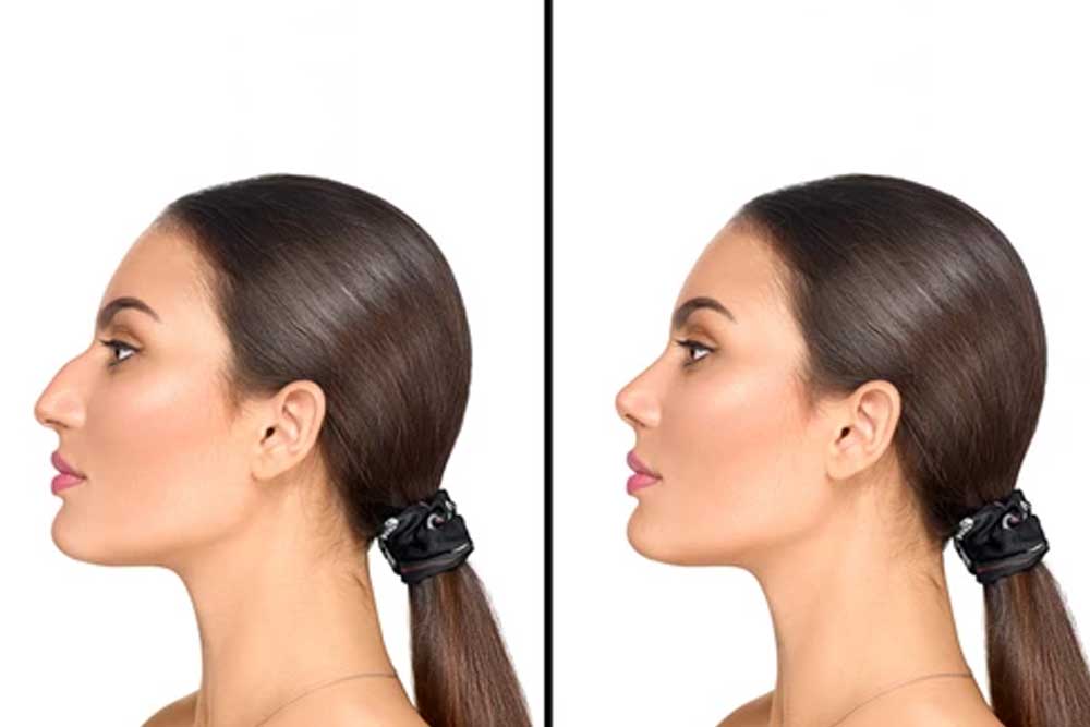 rhinoplasty before after