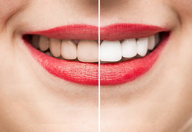 smile makeover before after