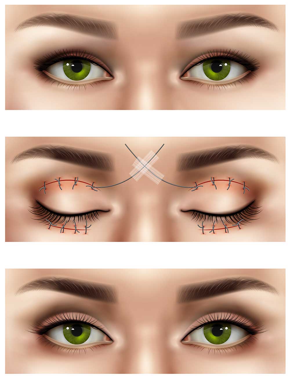 what is Blepharoplasty