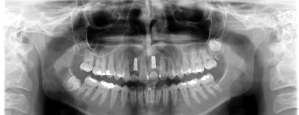 xray for implants